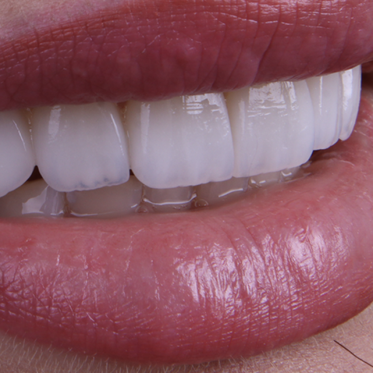 emax-laminate-veneers-3