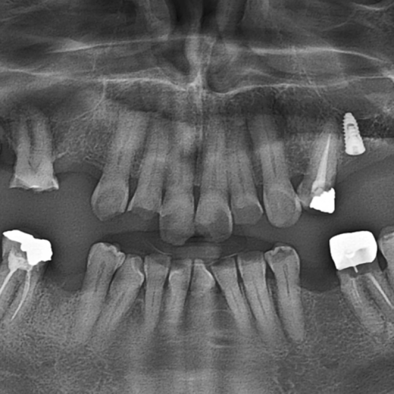 wisdom-tooth-extraction-clinic